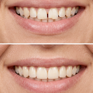 Veneers & Smile-Analyse – Maison Dental