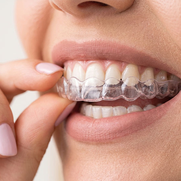 Invisalign – Maison Dental