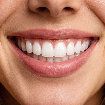 Veneers & Smile-Analyse – Maison Dental