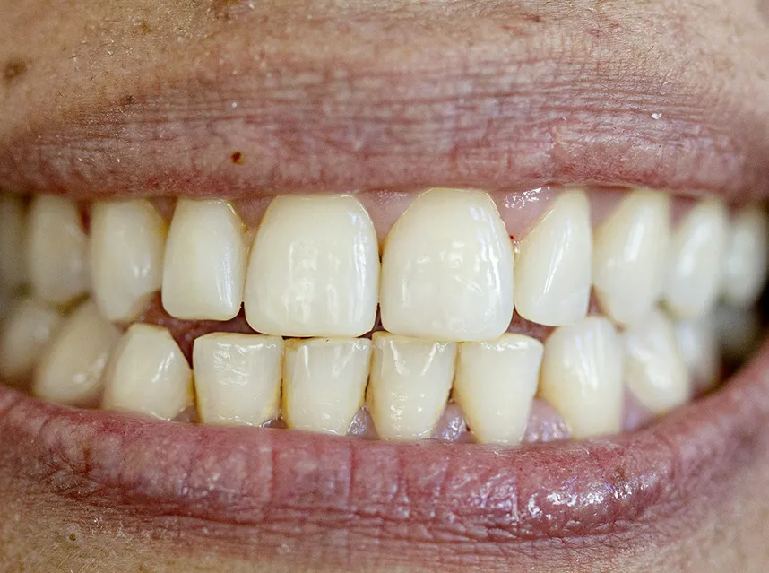 After Treatment