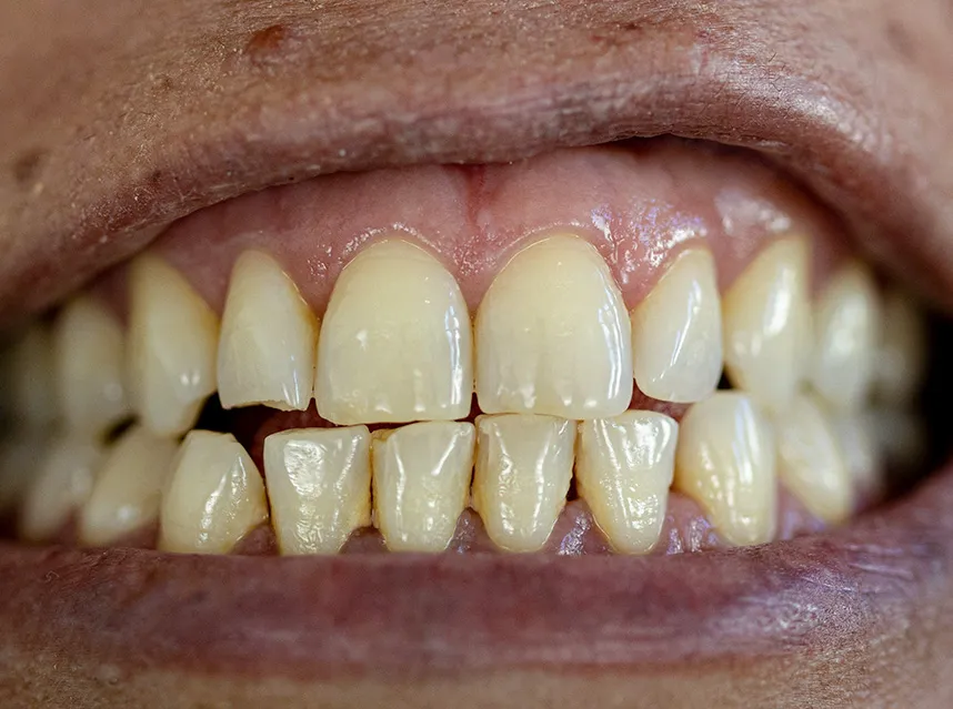 Before Treatment