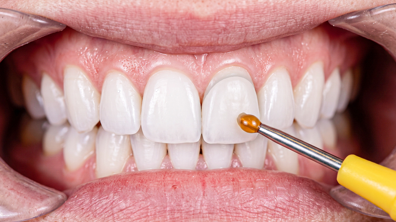 Veneers